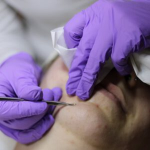 Es gibt eine Vielzahl an Behandlungen bei Akne